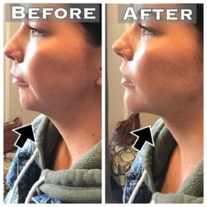 Chin augmentation
