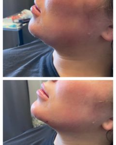 Chin augmentation