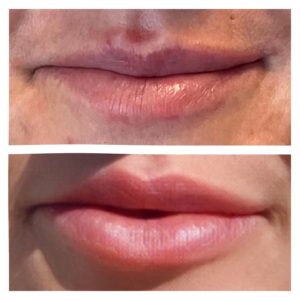 Symmetry correction and crisp clean lines! This was achieved with 1mL of @restylaneusa Kysse.