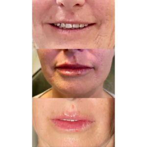 These results were achieved with 1mL of @juvederm ultra plus.