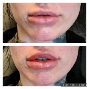 Luscious pout and asymmetry correction
