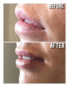 Amazing lips achieved with one syringe of Restylane Kysse