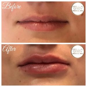 Stunning results with one syringe of #RestylaneKysse