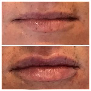Juvederm ultra plus