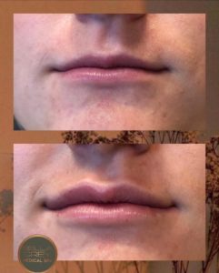 Subtle, natural-looking volume with one syringe of Juvéderm Ultra Plus