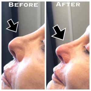 Our patient wanted to fix the awkward shape of the tip of her nose. Using half a syringe of #juvedermfiller we were able to achieve her desired results