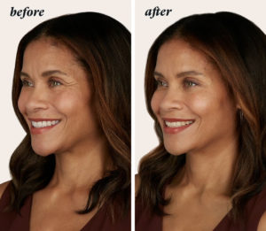 a before and after of a woman who had a Botox treatment