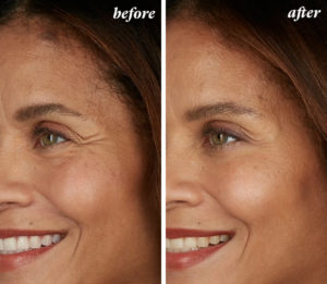 a before and after of a woman who had a Botox treatment
