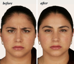 a before and after of a woman who had a Botox treatment