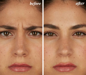 a before and after of a woman who had a Botox treatment