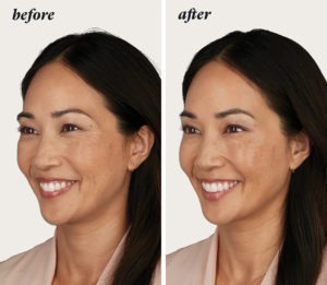 a before and after of a woman who had a Botox treatment