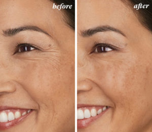 a before and after of a woman who had a Botox treatment
